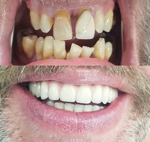 Failing, misshapen, missing teeth before smile in a day treatment at Bristol Almondsbury Dental Implant Clinic by Ioannis Kakisis.